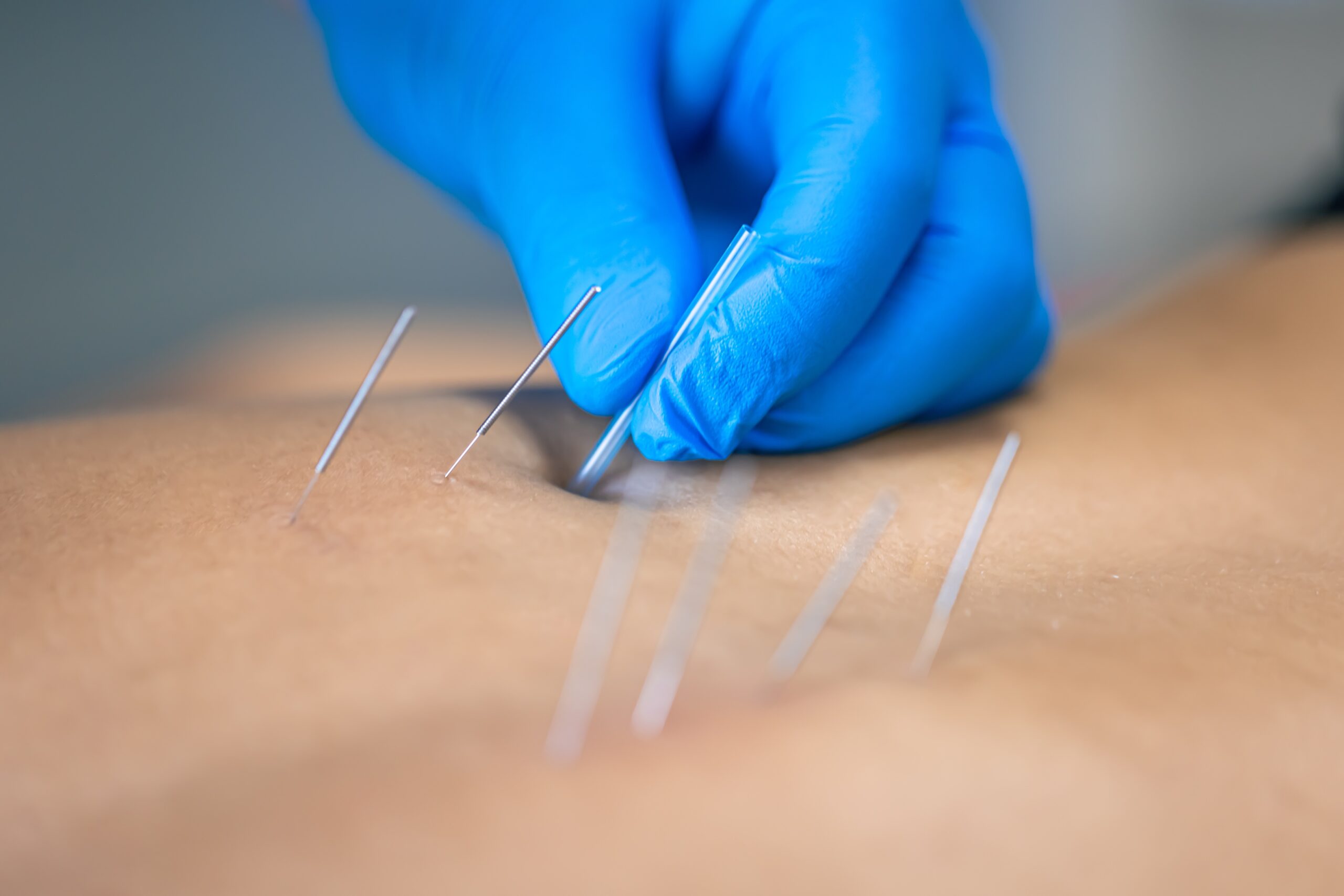 Dry Needling for Athletes: How It Speeds Up Recovery